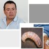 De 3 casos de Gusano Barrenador en humanos en Jalisco, uno es de Tenamaxtlán y otro de Autlán